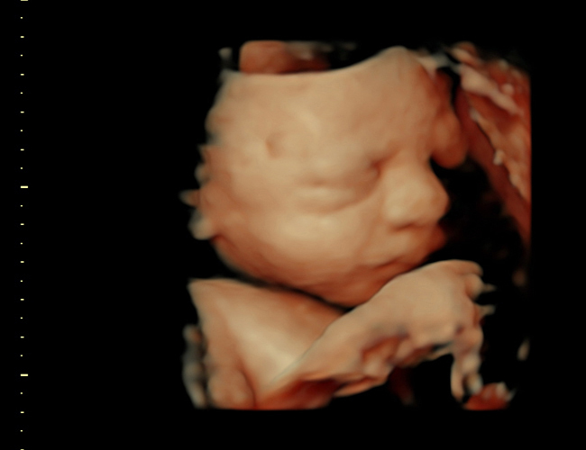3D ultrasound image at 31 weeks